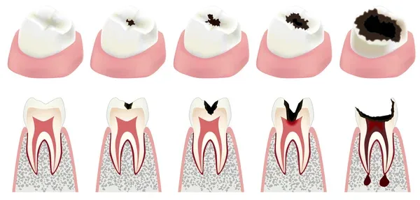 etapas de caries dentales