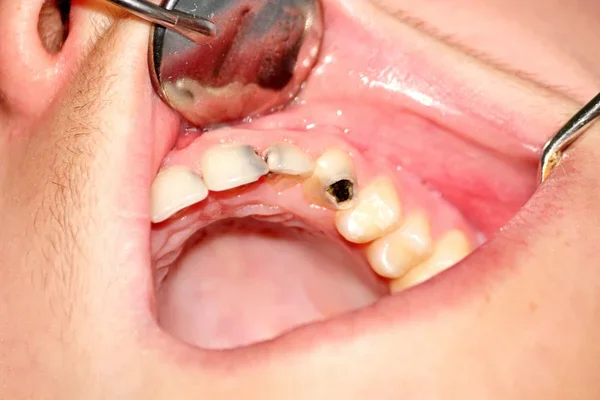 dientes afectados por caries dentales