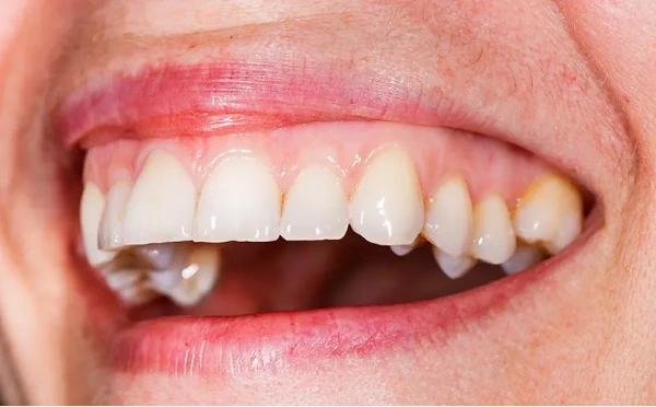 Importancia de mantener los dientes saludables para la salud general