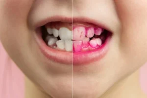 Placa bacteriana qué es, causas y cómo eliminarla