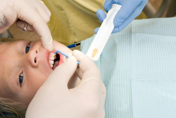 ¿Cómo se colocan los sellantes dentales?