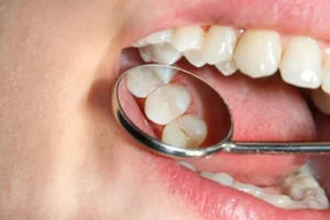 ¿Qué son los sellantes dentales y para qué sirven