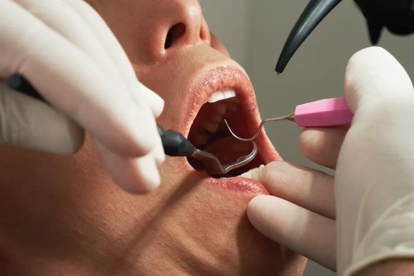 ¿Qué son los sellantes dentales?